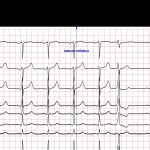STAFF III database published at Physionet
