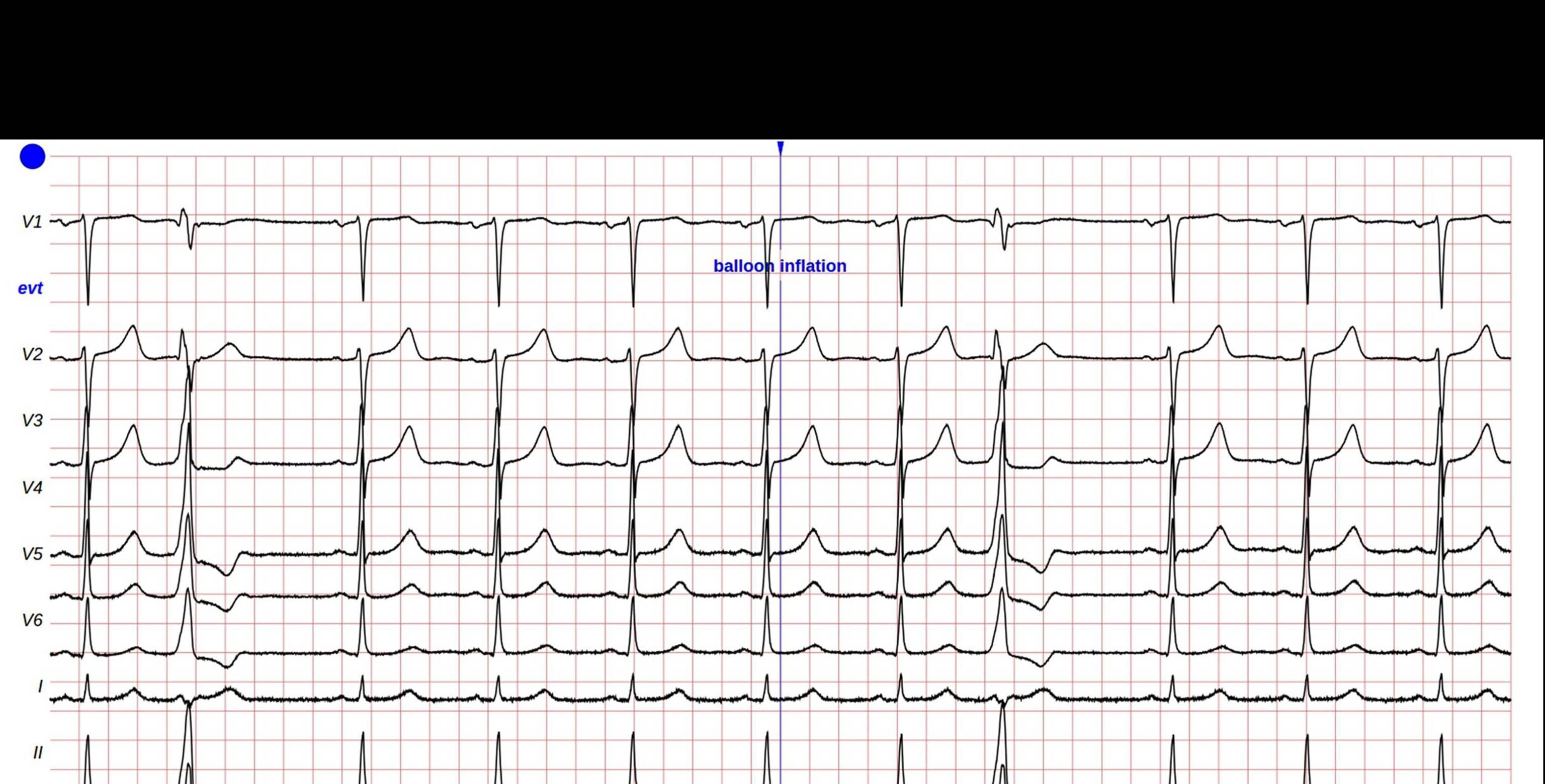 STAFF III database published at Physionet